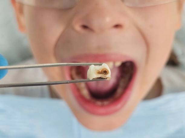 Best Knocked-Out Tooth (Avulsed Tooth) Treatment in Auburn Lake Trails, CA